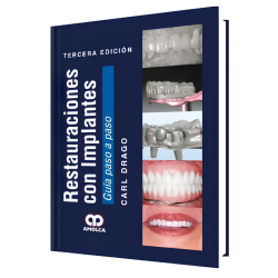 Restauraciones con Implantes. Guía Paso a Paso. 3 Edición