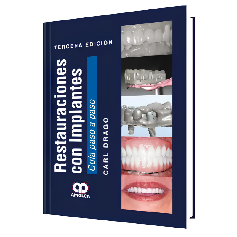 Restorations with implants. Step by step guide. 3 edition