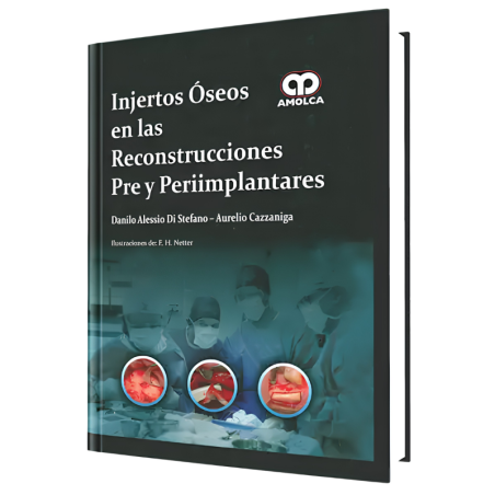 Injertos Óseos en las Reconstrucciones Pre y Periimplantares