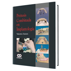 Prótesis Combinada en Implantología