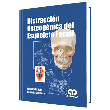 Osteogenic distraction of the facial skeleton