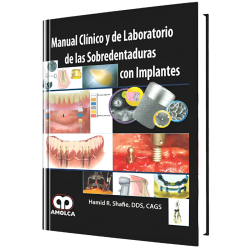 Clinical and Laboratory Manual of Overdressings with Implants