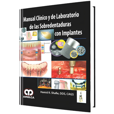 Clinical and Laboratory Manual of Overdressings with Implants